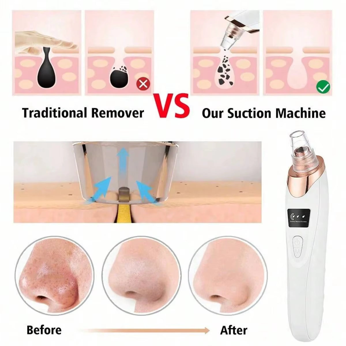 2026 Ultimate Facial Pore Cleaner - 5 Suction Levels Blackhead Remover & Rechargeable Vacuum Kit